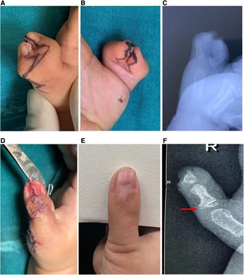 Aesthetic outcomes of and anatomic reconstruction for Wassel type IV-D radial polydactyly using a modified Bilhaut-Cloquet procedure